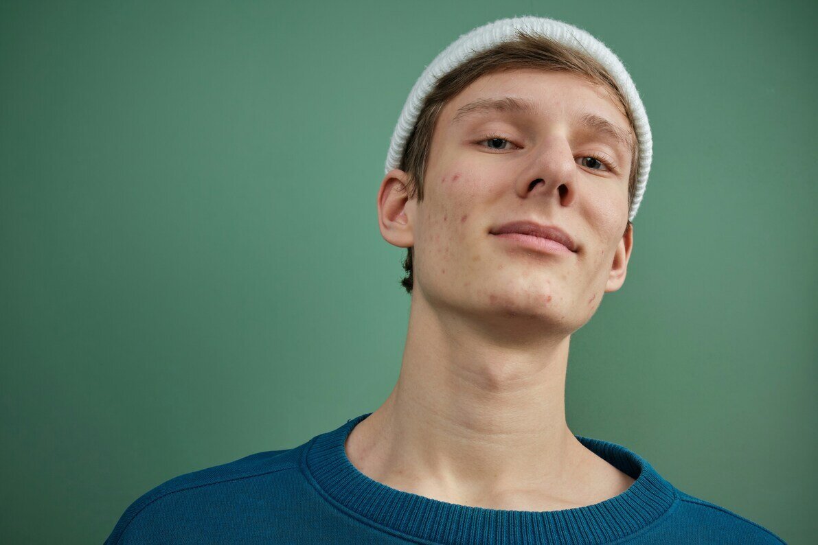 Rosacea hero image