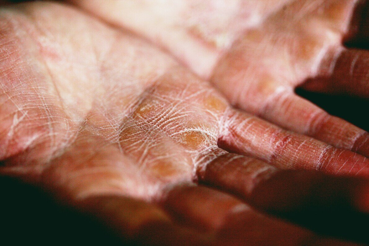 Eczema hero image