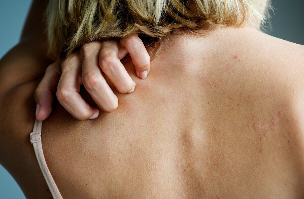 Psoriasis hero image