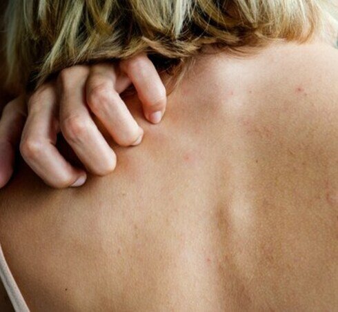 Psoriasis